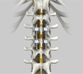 Spinal Fixation and Fusion