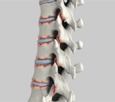 Ankylosing Spondylitis