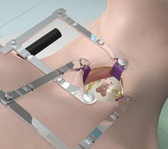 Anterior Cervical Discectomy and Fusion