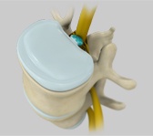 Cervical Disc Prolapse