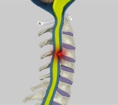 Cervical Myelopathy