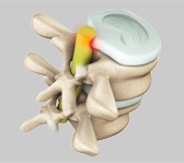 Cervical Radiculopathy