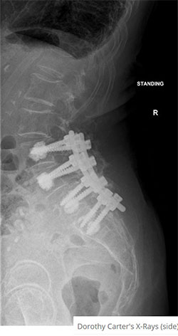 Dorothy Carter's X-Rays (side)

