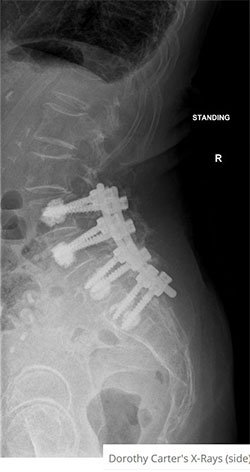 Dorothy Carter's X-Rays (side)
