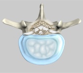 Degenerative Disc Disease