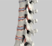 Degenerative scoliosis