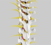 Facet Joint Arthritis