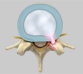 Herniated Disc