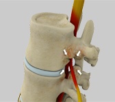 Lumbar Stenosis