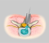 Minimally Invasive Spine Surgery