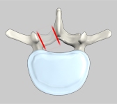 Posterior Cervical Foraminotomy