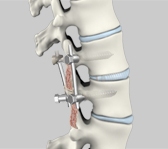 Second opinion and Revision Lumbar Surgery