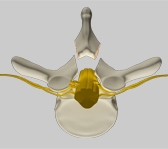 Skip Laminectomy