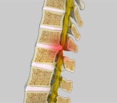 Spinal Cord Compression