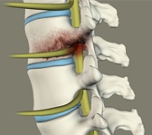 Spinal Infection