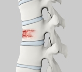 Removal of Spinal Tumours