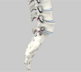 Spondylolisthesis