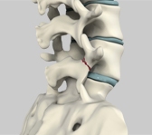 Spondylolysis