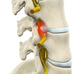 Thoracic Disc Disease